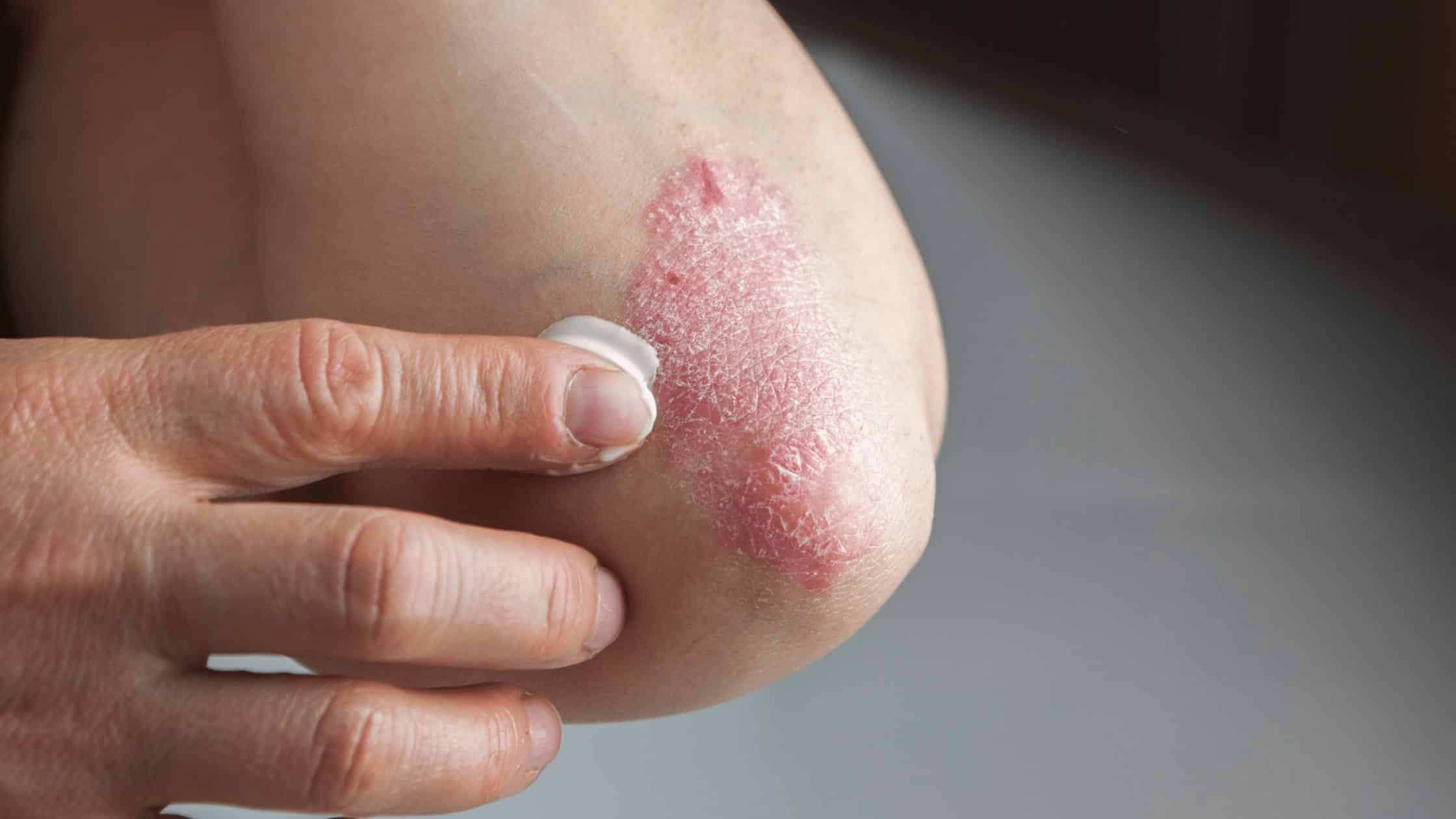 Person's elbow with psoriasis applying ointment